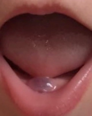 Гематома прорезывания.