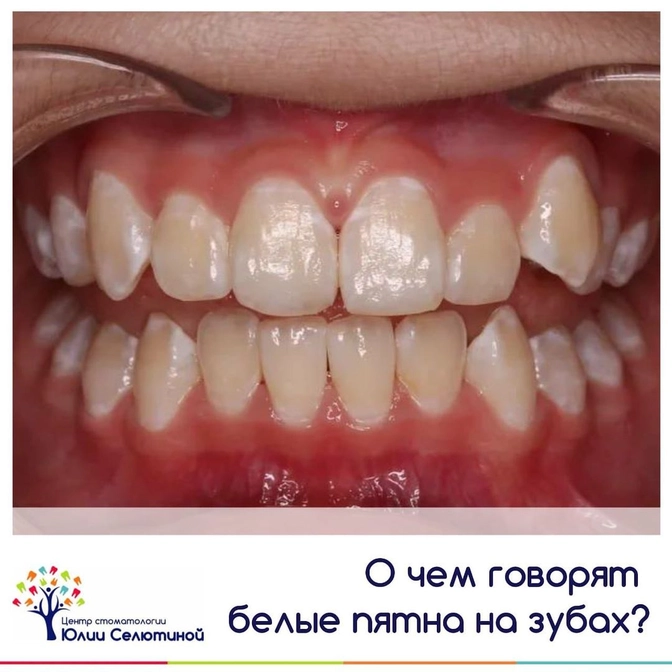 О чем говорят белые пятна на зубах?