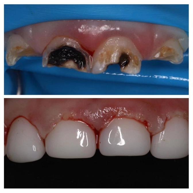 Агрессивный кариес раннего детского возраста 