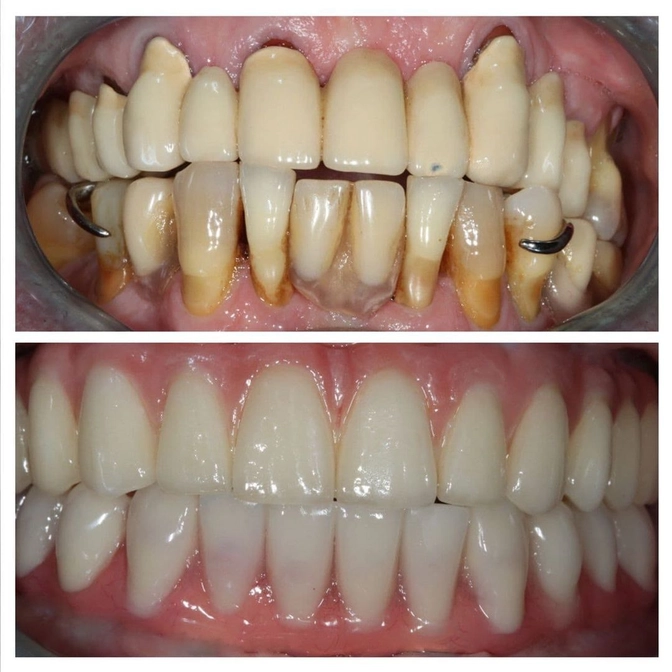 Тотальная реабилитация с установкой имплантов. 