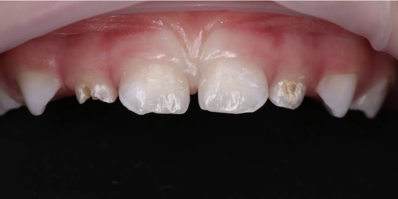 Изображение зубов до прихода в клинику