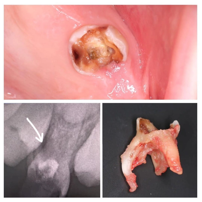 Резорцин-формалиновый метод лечения зубов: почему мы его не используем? 