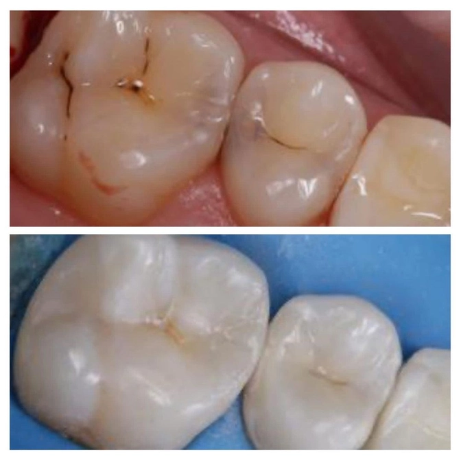 Скрытый кариес ...