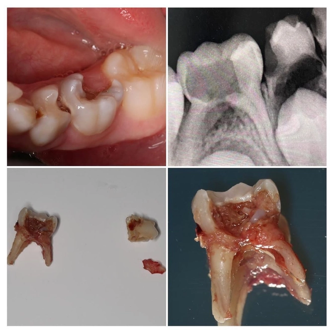 Зачем лечить молочные зубы? 