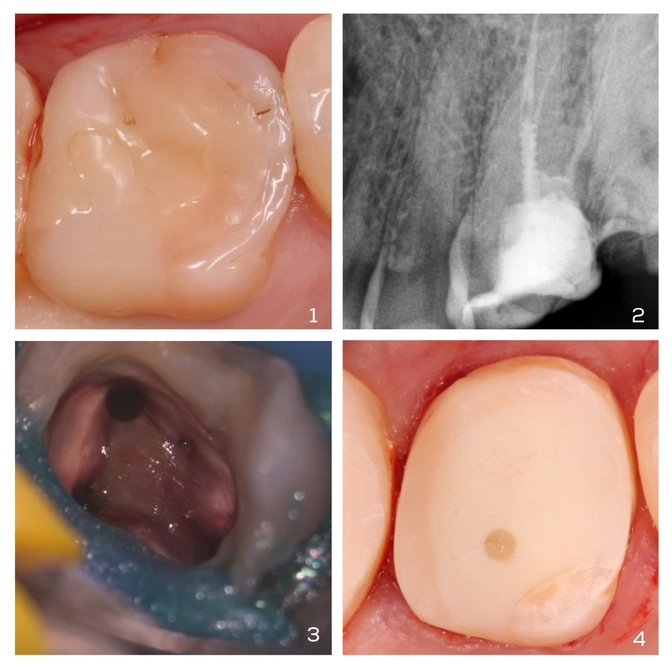 Перелечивание "резорциненного" зуба 