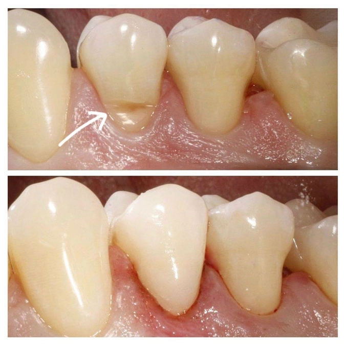 В чем причина клиновидного дефекта?