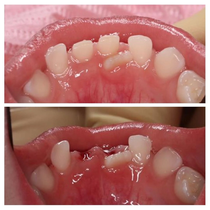 Что делать, если постоянный зуб не выпадает.