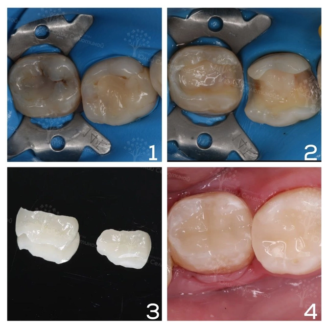 Замена старых пломб вкладками Emax 