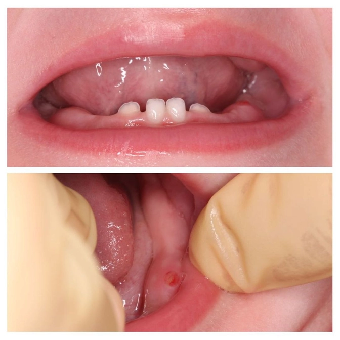 Травма десен у ребёнка: что делать? 