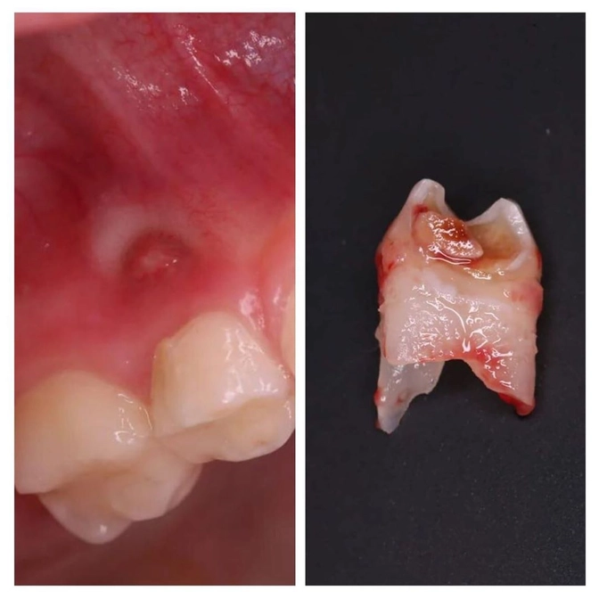 Свищ: что делать? 