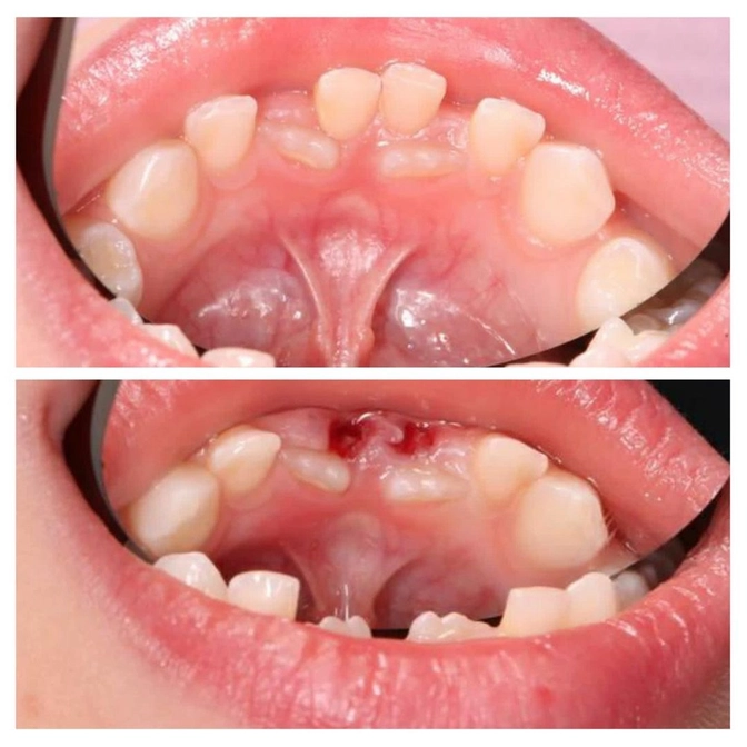 Что делать, если постоянный зуб прорезался, а молочный еще не выпал? 