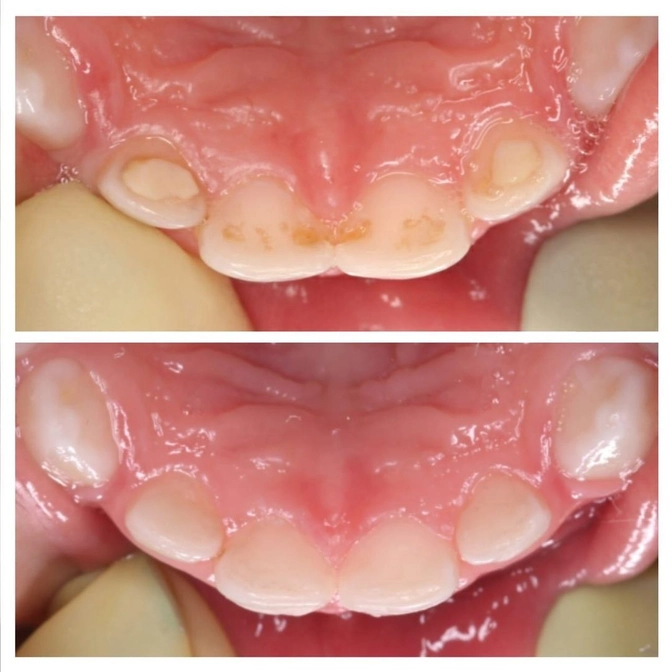 Всегда ли лечение малышей проходит под наркозом? 