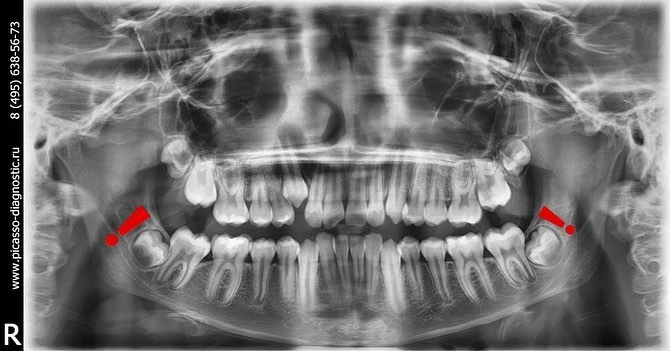 Зубы "мудрости"