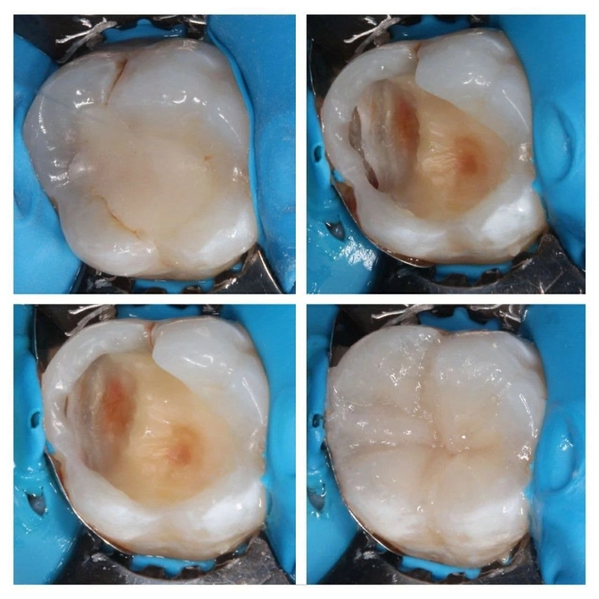 Лечение вторичного кариеса 