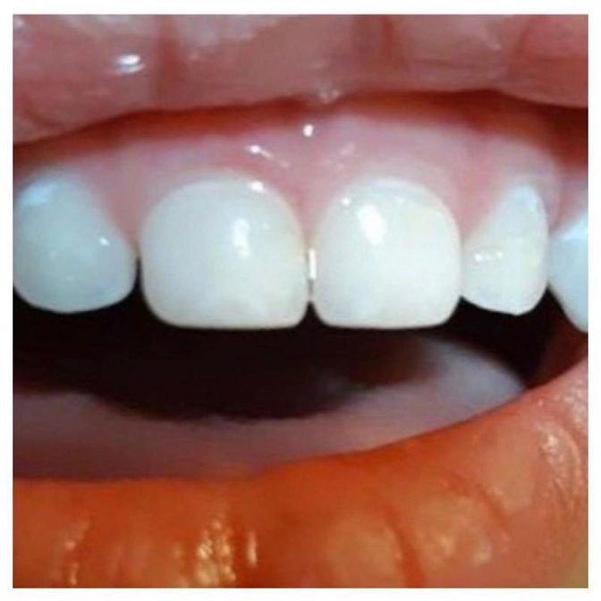 Кариес в стадии пятна: методы лечения и перспективы.