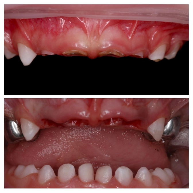 Лечение молочных зубов под наркозом 