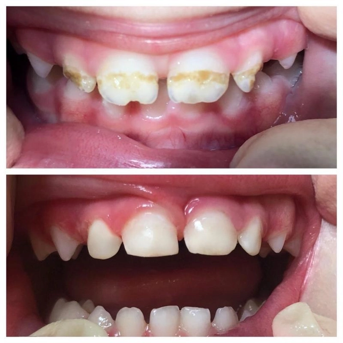 Лечение центральных зубов.