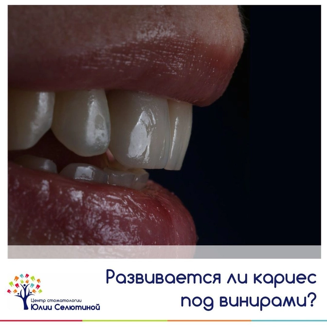 Развивается ли кариес под винирами? 
