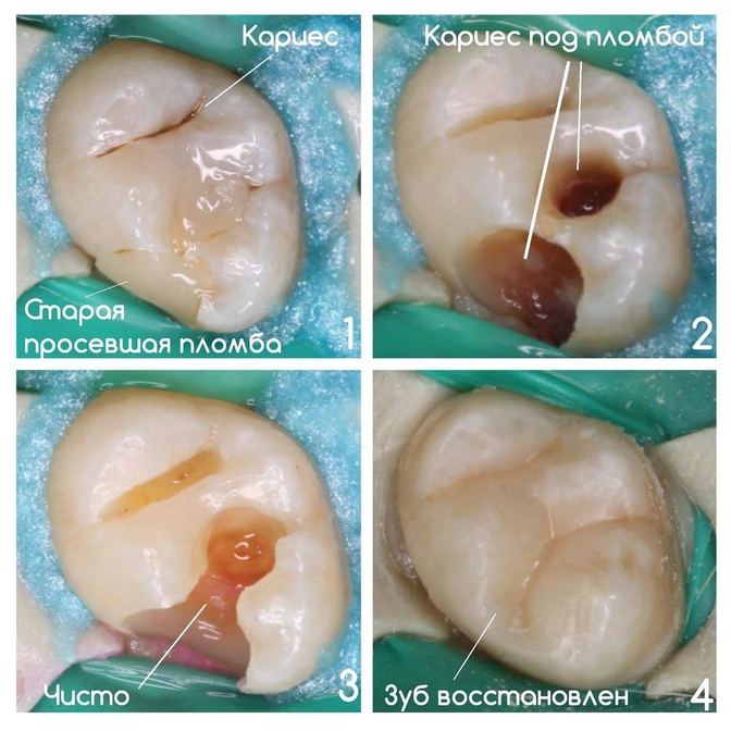 Замена старой пломбы: вторичный кариес.
