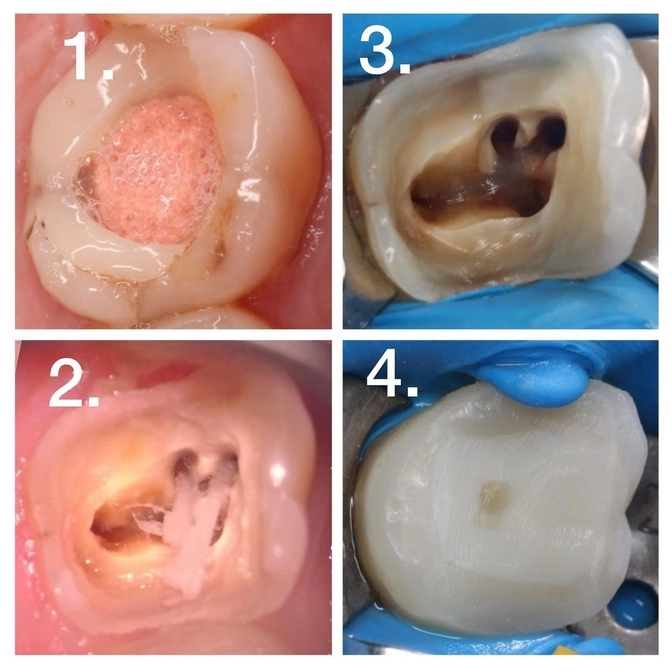 Клинический случай: перелечивание каналов с обломком инструмента 