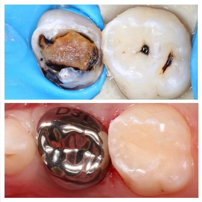 Лечение молочного зуба с постановкой коронки. 
