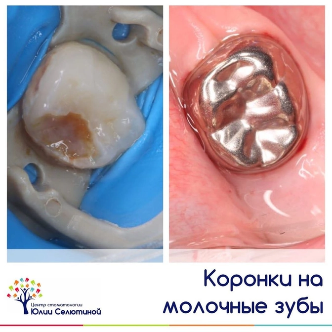 Лечение молочных зубов с применением коронок. 