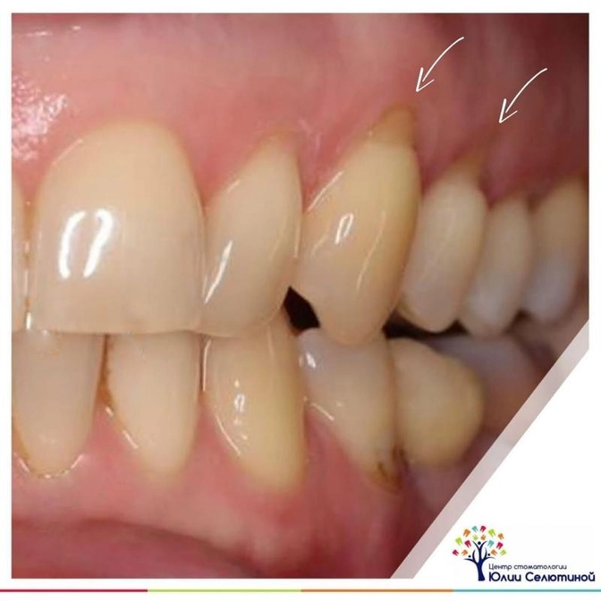 Что делать, если оголяются шейки зубов?