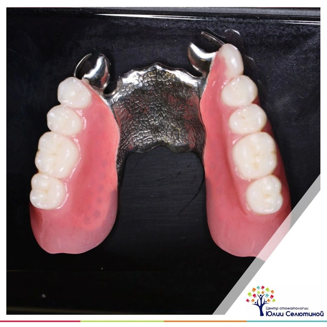 Бюгельный протез. 