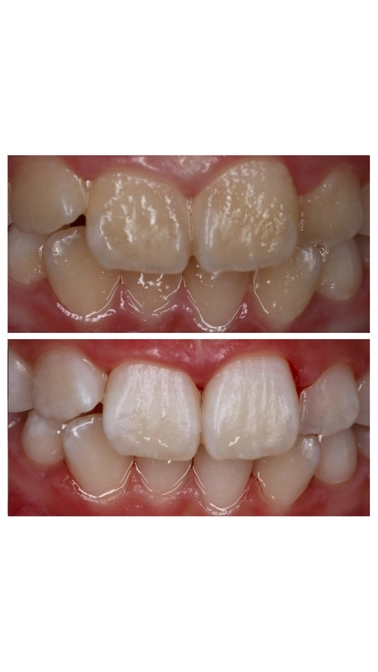 Как часто нужна профессиональная гигиена полости рта? 