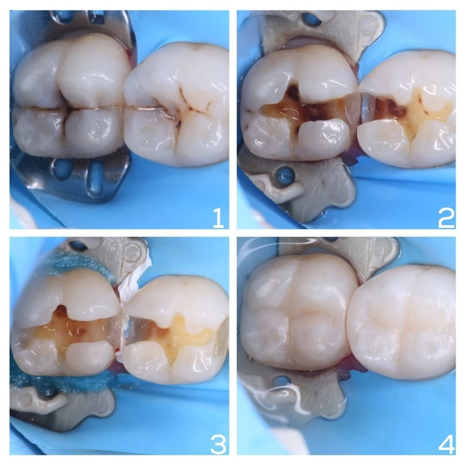 Нужно ли лечить фиссурный кариес? 