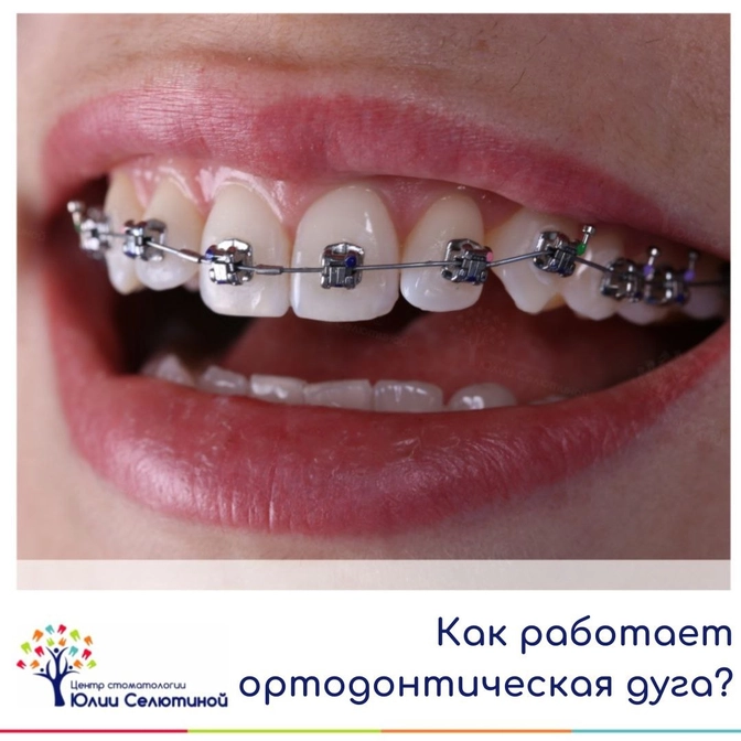 Как работают брекеты?