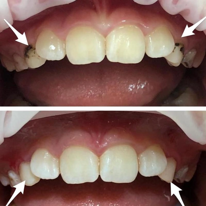 "Эстетика" серебрения молочных зубов.