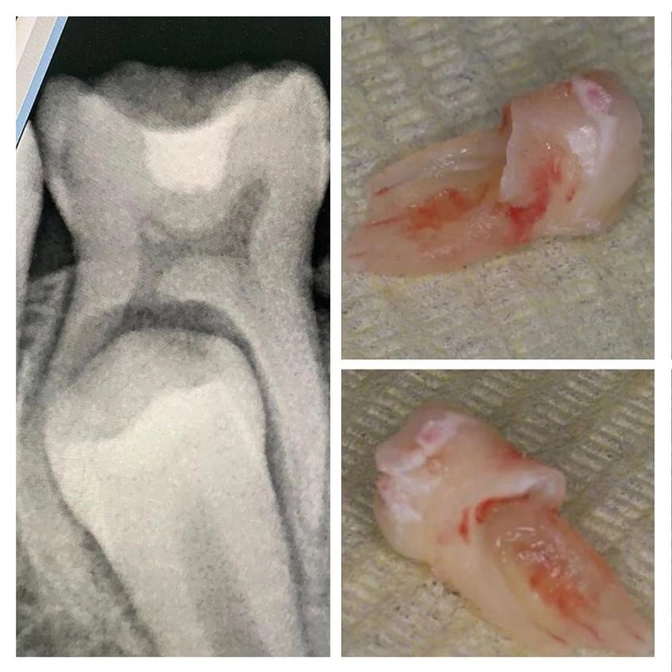 Когда удалять молочный зуб?