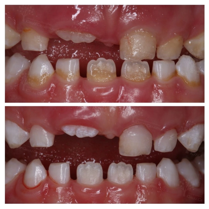 Снятие тёмного зубного налета у ребёнка 