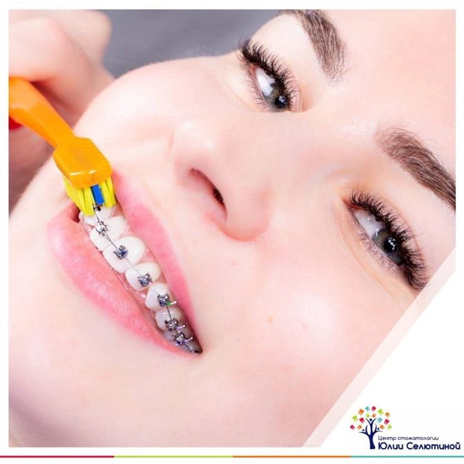 Как чистить зубы в брекетах?