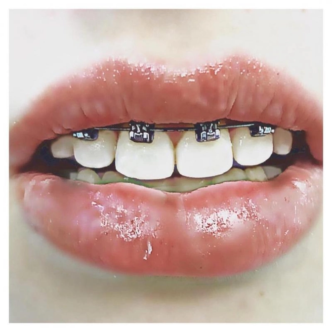 Экспозиция резцов.