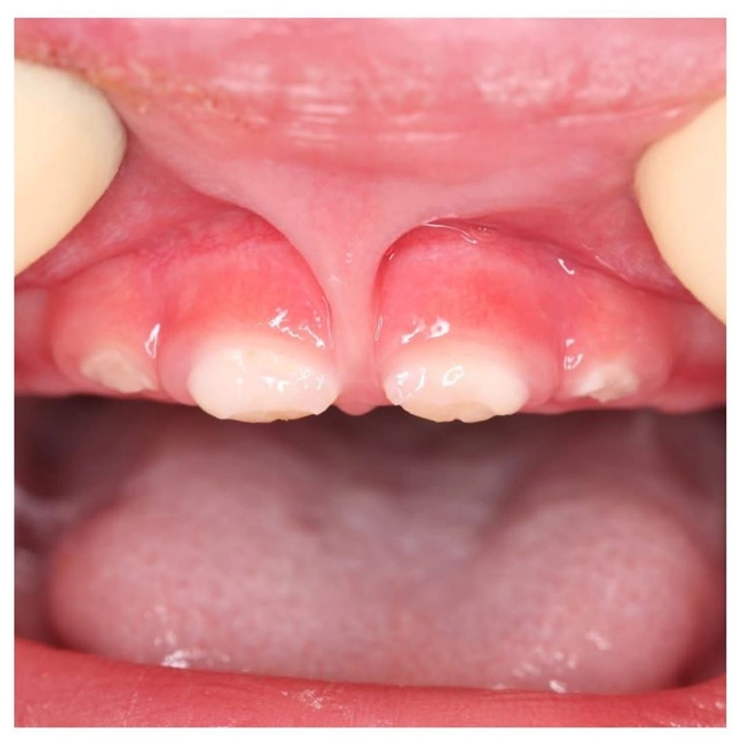 Агрессивный кариес раннего детского возраста