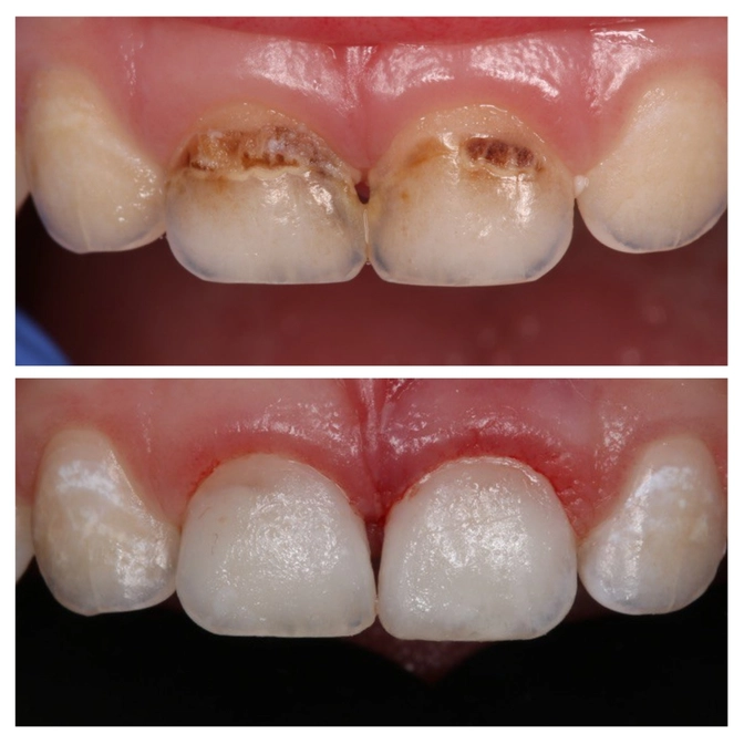 История маленького пациента: как кариес стабилизировался на несколько лет