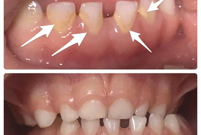 Зубной камень у детей. Клинический случай.