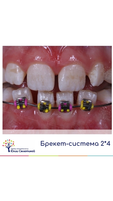 Частичная брекет-система у детей