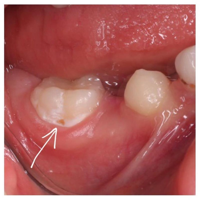 Что может быть при плохой гигиене полости рта?