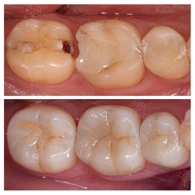 Пломба иди вкладка?