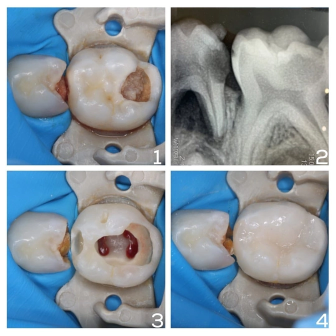 Лечение молочных зубов на первом посещении 