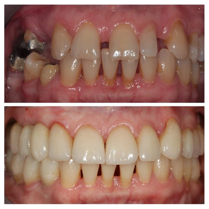 Улучшение улыбки без ор один и че кого лечения: клинический случай. 