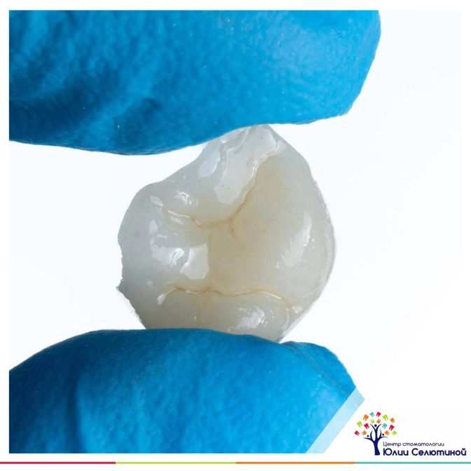 Керамическая вкладка или пломба: плюсы и минусы