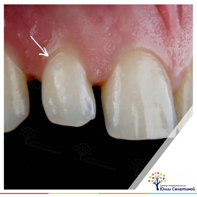 Mock-up: примерка макета будущих коронок 