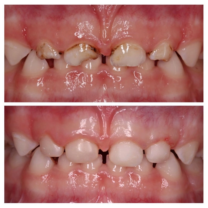 Реставрация центральных молочных зубов у ребёнка.