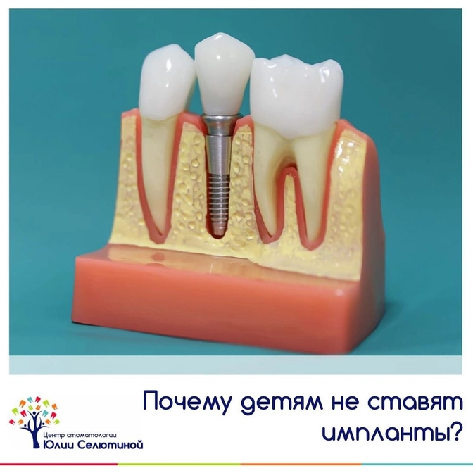 Почему детям не ставят импланты?