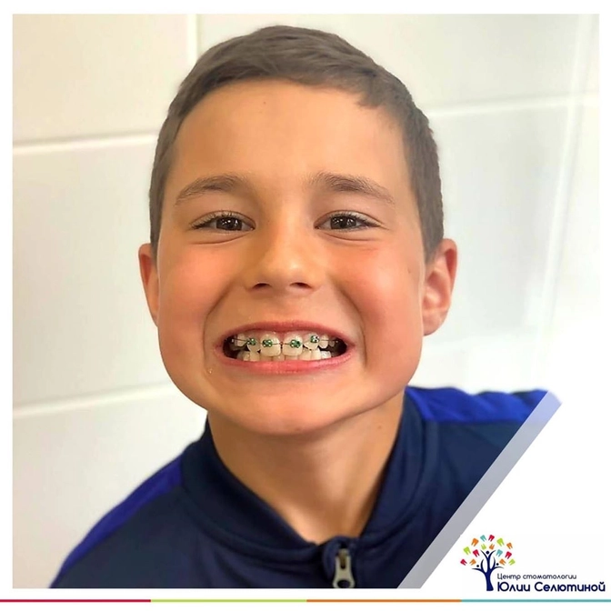 Когда брекеты ставятся не на все зубы? 