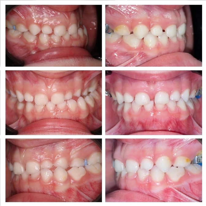 Лечение неправильного прикуса: перекрестный прикус.